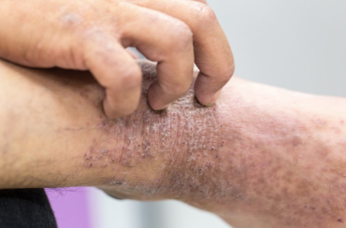 Understanding Eczema and How Saffron Intensive Moisturising Balm Can Help