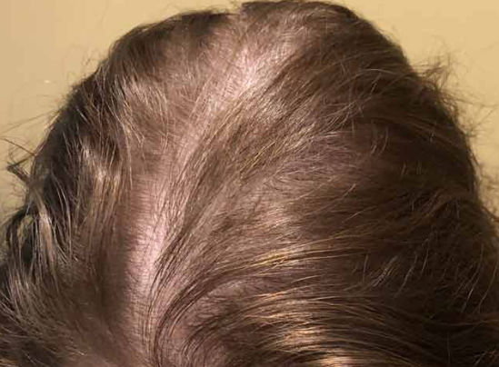 How Regional Shower Water Can Cause Hair Loss & What You Can Do About It