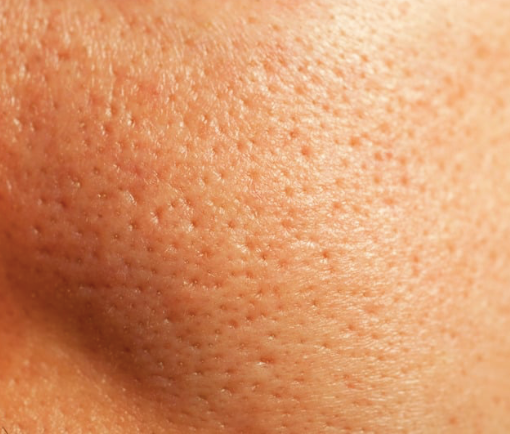 The Truth About Pore Shrinking: What Really Works (And What Doesn’t!)