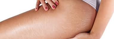 What is stretch marks and  how to get rid of them