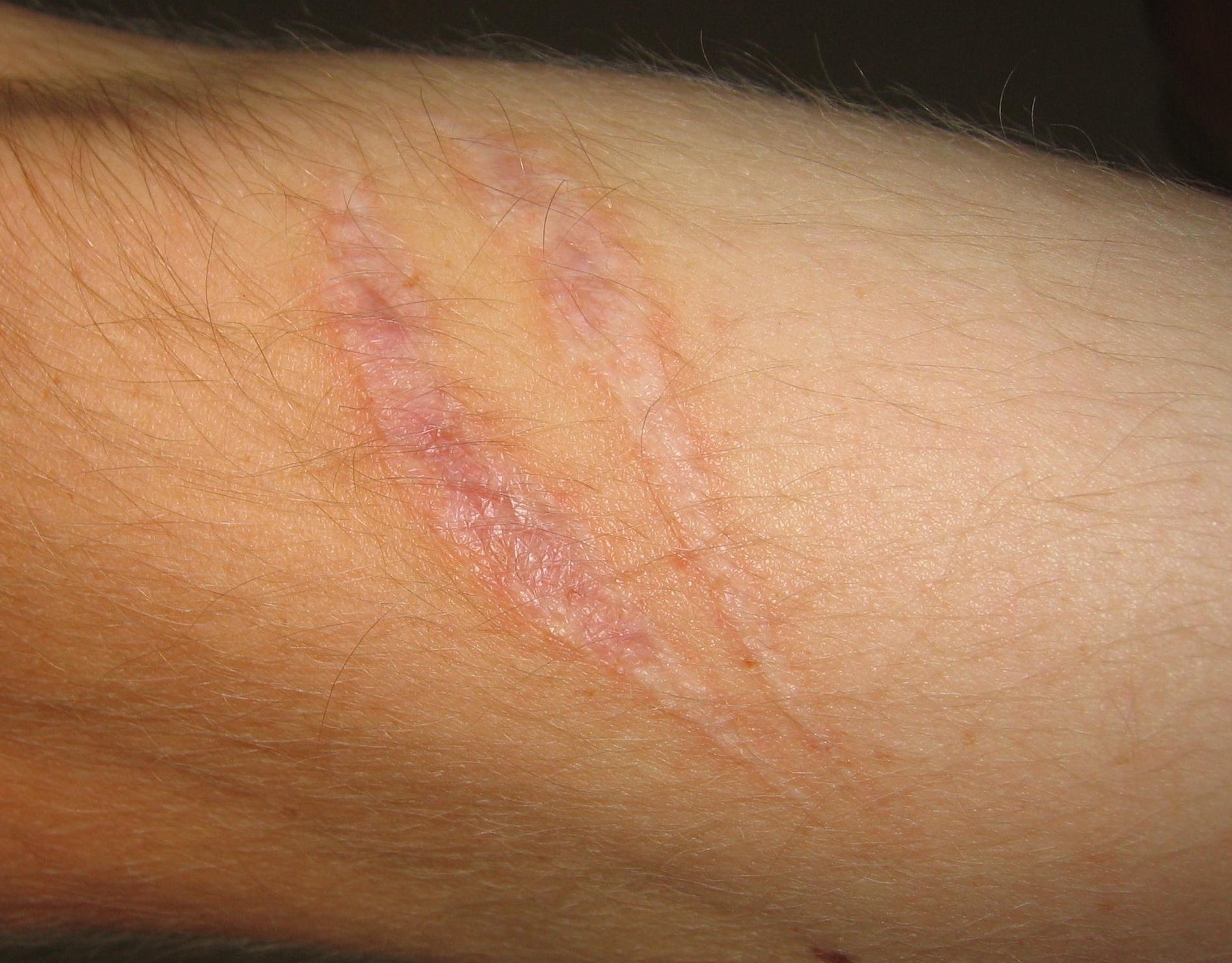 Body marks and scarring