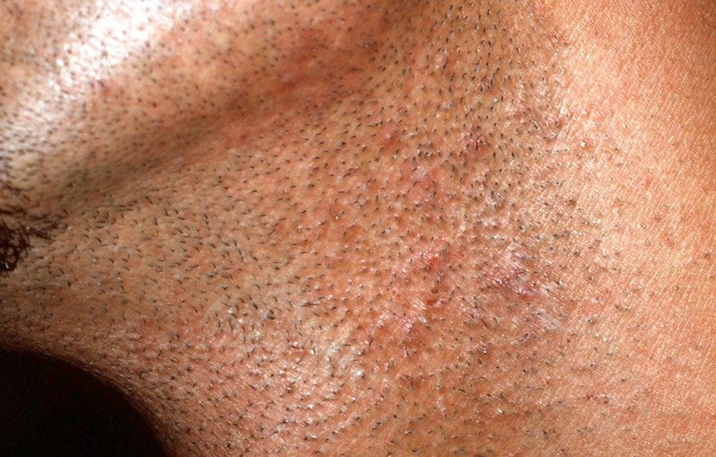 Why do you get shaving bumps and how to get rid of them.
