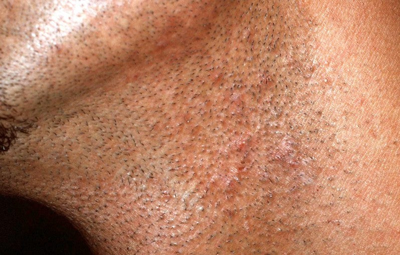 How To Get Rid Of Pubic Shaving Bumps